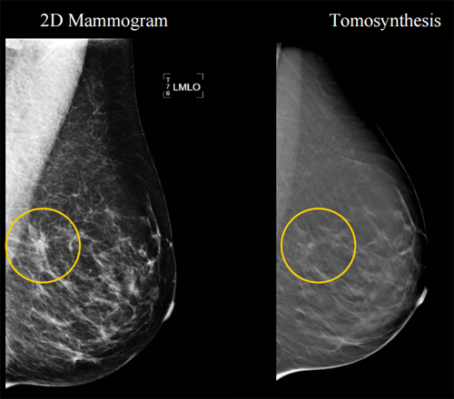Breast tomosynthesis dose
