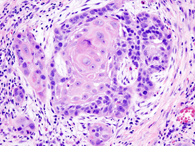 Biópsia de carcinoma de células escamosas, um dos tipos de câncer de pele não-melanoma - Foto: Wikimedia Commons