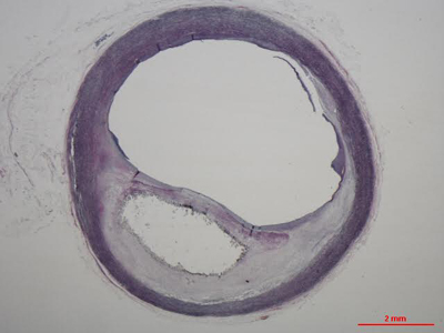 Artéria carótida comum com placa de aterosclerose - Foto: Arquivo pessoal da pesquisadora Claudia Suemoto