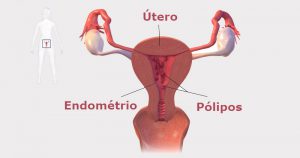 Pólipo uterino pode não estar associado ao câncer de endométrio