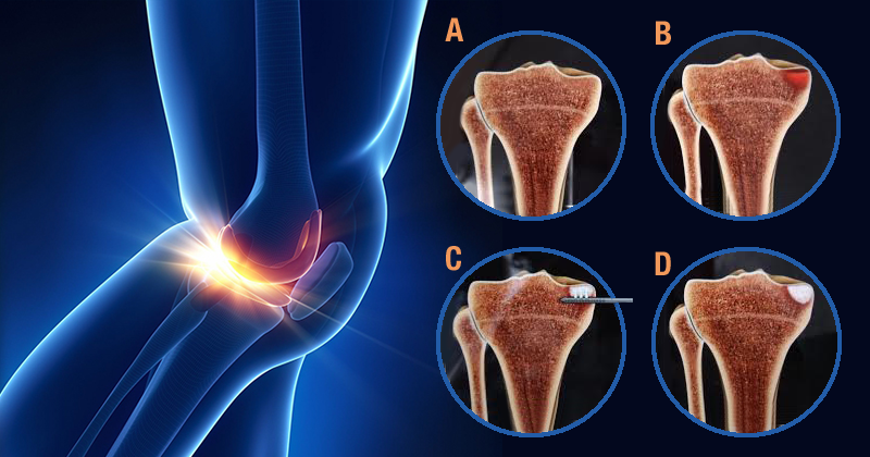 recuperare din leziuni la genunchi cel mai bun unguent pentru osteochondroza cervicală