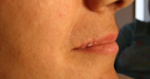 Gel produzido na USP é capaz de secar feridas da herpes labial