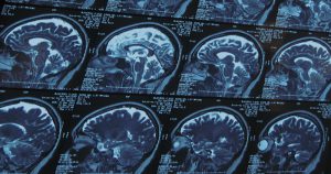 Especialista comenta as novas resoluções sobre morte cerebral