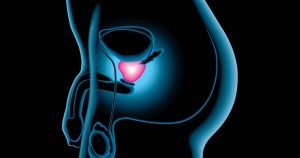 Brasil trata câncer de próstata com qualidade