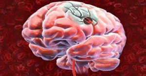 Novidades no tratamento do Acidente Vascular Cerebral