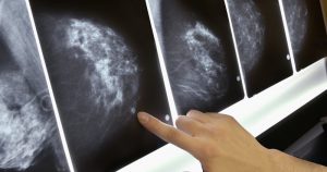 Tratamento de câncer de mama pode ter menos efeitos colaterais