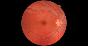 Estudo premiado indica melhor método para tratar retinopatia diabética