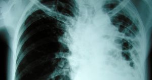 Diagnóstico da fibrose cística é fundamental para tratamento