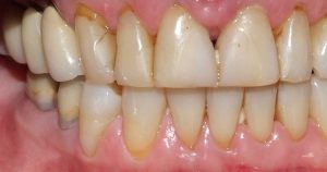 Periodontite em adultos é a principal causa de perda de dentes
