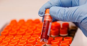 Especialista alerta para importância do teste sorológico HIV