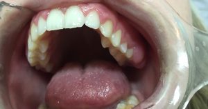 Análise de proteína na saliva indica evolução de câncer de boca