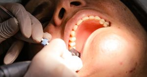 Seus implantes dentários estão saudáveis? Pesquisa pode ajudar a descobrir