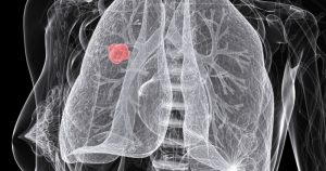 Problemas no pulmão podem levar ao infarto e ao câncer