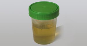 Novo método detecta câncer de próstata por meio da urina