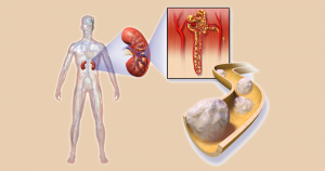 Câncer nos rins é doença de difícil diagnóstico precoce