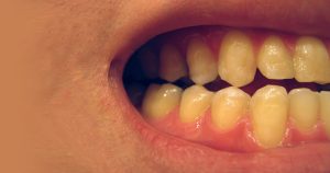 Materiais bioativos ajudam a manter a saúde dos dentes