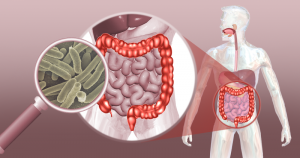 Microrganismos intestinais podem ajudar a diagnosticar câncer colorretal