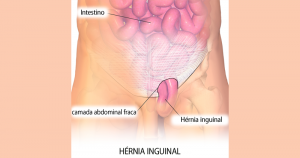 Entenda como acontecem as hérnias inguinais