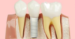 Pessoas com implantes dentários doentes podem fazer tratamento na USP