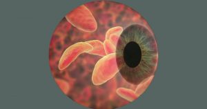 Parasita da toxoplasmose causa lesão típica e se espalha pela retina
