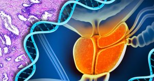 Biomarcadores na urina ajudam a identificar câncer de próstata