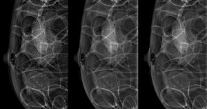 Nova técnica de processamento de imagem reduz radiação em exames de mama