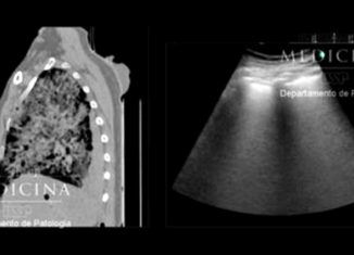 A tomografia computadorizada do tórax mostra sinais de pneumonia viral 

Crédito: Departamento de Patologia da Faculdade de Medicina da USP