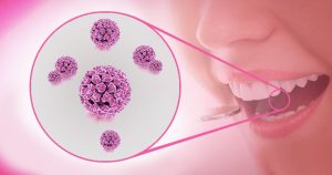 Em SP, cresce risco de câncer de boca associado ao vírus HPV, aponta estudo