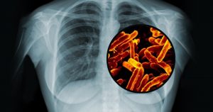 Novas moléculas inibem enzima importante para a bactéria da tuberculose