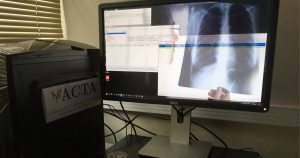 Software ajuda a prever mortalidade em pacientes que tiveram embolia pulmonar aguda