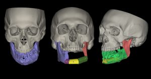 Hospital Universitário da USP realiza cirurgia com apoio de impressora 3D