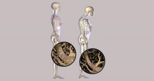 Osteoporose, doença silenciosa que pode ser fatal