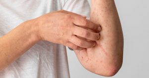 Exposição no Hospital das Clínicas conscientiza público sobre a dermatite atópica
