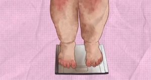 Risco de queda: mulheres com obesidade mórbida têm menos sensibilidade na sola dos pés e déficit de equilíbrio
