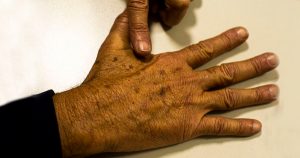 Câncer de pele é o tipo mais frequente no Brasil