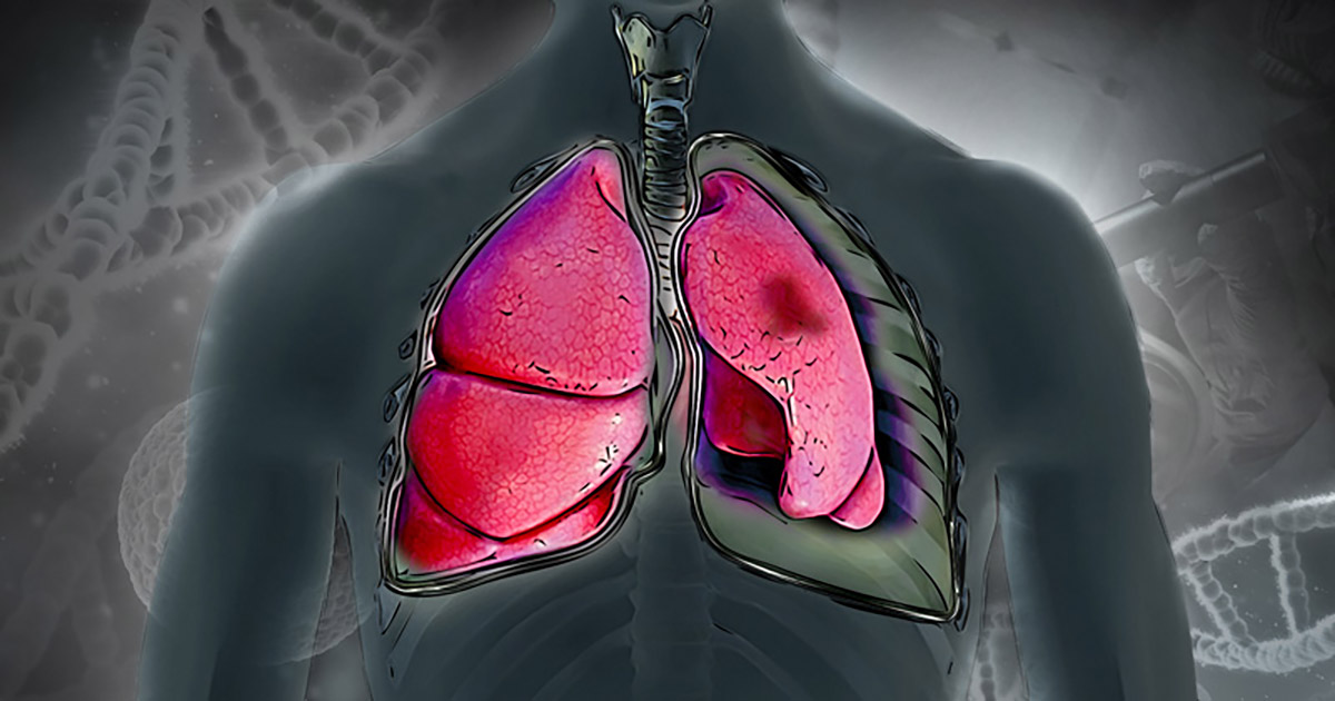 Imagem de um gráfico em que pulmões, destacados na cor vermelha, se sobrepõem a um tórax humano esboçado em cores escuras, sendo que o pulmão direito de quem vê a imagem (correspondendo ao esquerdo do perfil toráxico) apresenta uma mancha escura indicativa de um câncer 