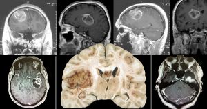 Glioblastoma: descoberto mecanismo capaz de reverter resistência do tumor cerebral a radioterapia