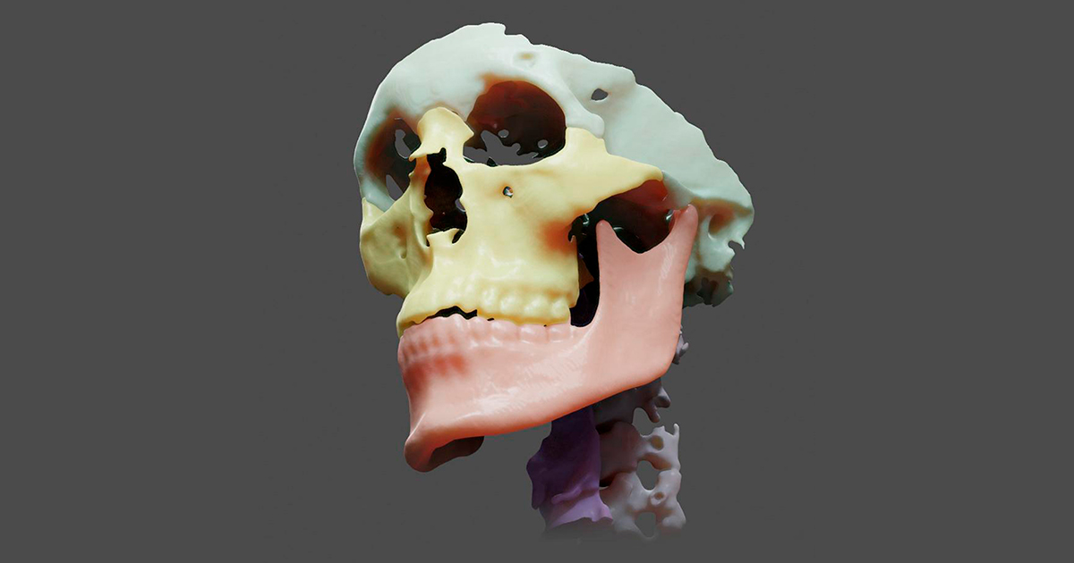 20240508_capa-cranio