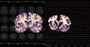 Imagens de ressonância magnética e de eletroencefalograma sobre um fundo escuro; à frente, fatias transversais do cérebro em tons de roxo e creme