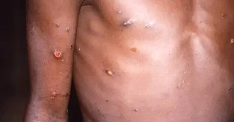 Visão de parte de um torso de um homem tomado por pequenas bolhas do vírus Mpox