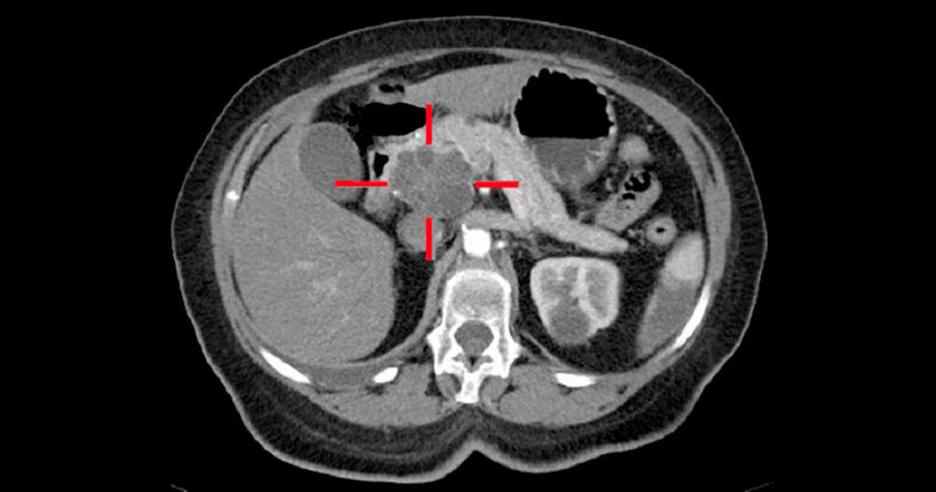  Imagem de uma tomografia realizada em um humano na área do corpo onde se encontra o pâncreas