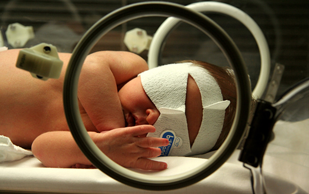 Bebê em incubadora recebe luz para tratamento de icterícia. Ele usa um tapa olhos para proteção.