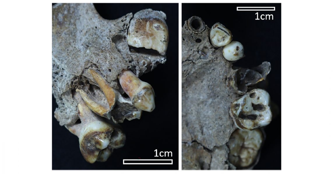 Foto da arcada dentária junto com os dentes cariados e com alterações morfológicas - Foto: Artigo científico publicado