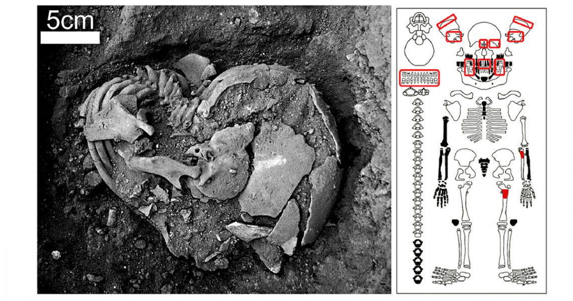 Foto do sepultamento durante a escavação e esquema do esqueleto indicando onde se localizavam as evidências da sífilis congênita assinaladas em vermelho: ossos do crânio, dentes, tíbia e fêmur.  Os ossos assinalados em preto não foram encontrados na escavação - Foto: Artigo científico publicado