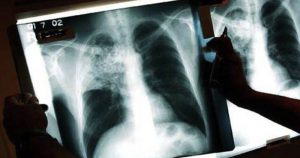 Governo tem nova medicação para tratar tuberculose em crianças